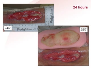 Polymem Application Comprehensive Overview of PolyMem® Wound Care Technology and Pain ...