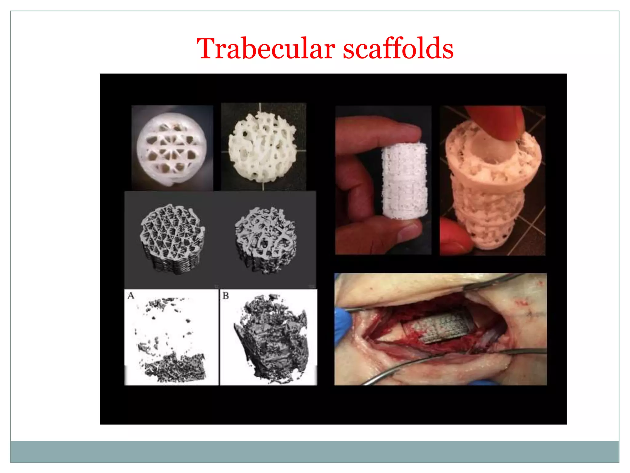 Trabecular scaffolds
 