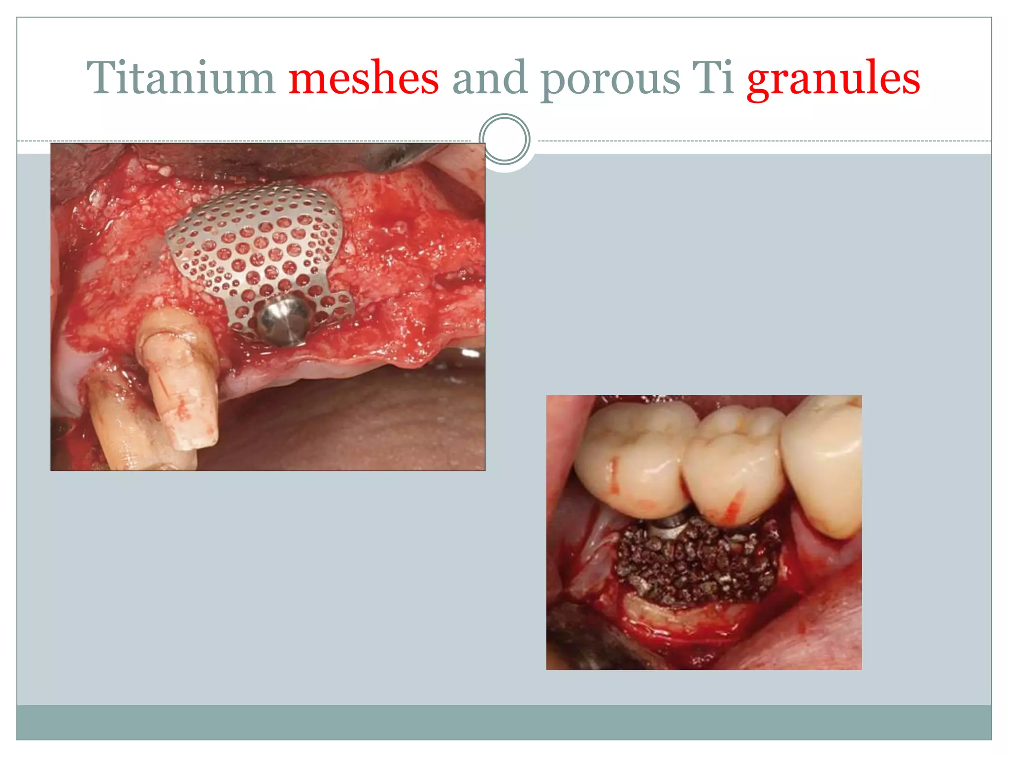 Titanium meshes and porous Ti granules
 