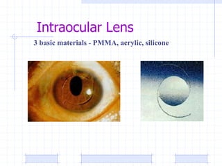 Intraocular Lens
3 basic materials - PMMA, acrylic, silicone
 