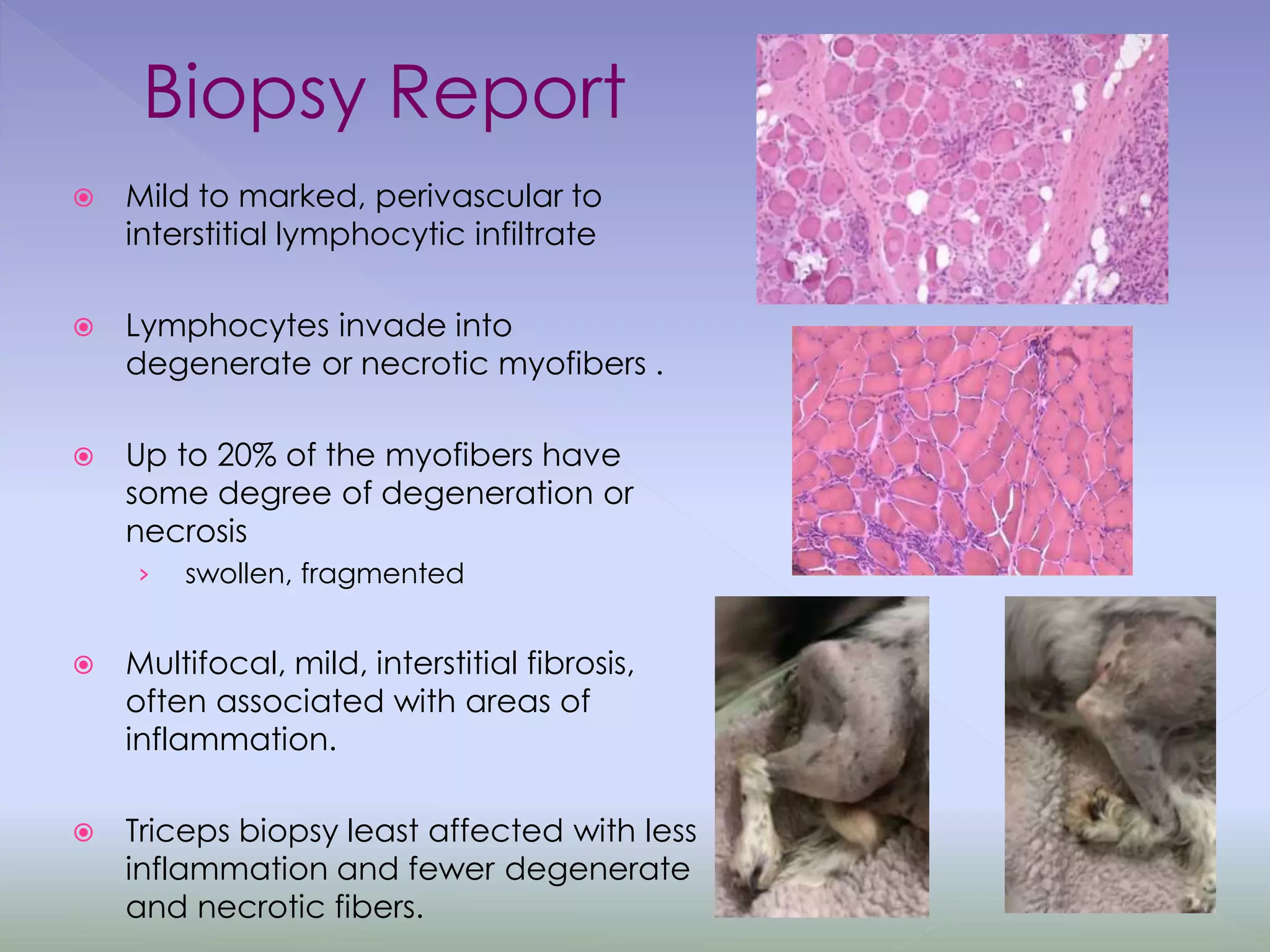 Biopsy Report
 Mild to marked, perivascular to
interstitial lymphocytic infiltrate
 Lymphocytes invade into
degenerate or necrotic myofibers .
 Up to 20% of the myofibers have
some degree of degeneration or
necrosis
› swollen, fragmented
 Multifocal, mild, interstitial fibrosis,
often associated with areas of
inflammation.
 Triceps biopsy least affected with less
inflammation and fewer degenerate
and necrotic fibers.
 