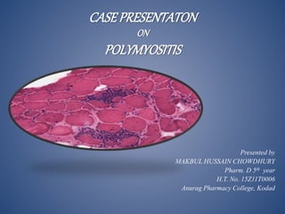 CASEPRESENTATON
ON
POLYMYOSITIS
Presented by
MAKBUL HUSSAIN CHOWDHURY
Pharm. D 5th year
H.T. No. 15Z11T0006
Anurag Pharmacy College, Kodad
 