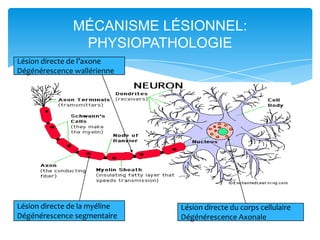 MÉCANISME LÉSIONNEL:
                PHYSIOPATHOLOGIE
Lésion directe de l’axone
Dégénérescence wallérienne




Lésion directe de la myéline   Lésion directe du corps cellulaire
Dégénérescence segmentaire     Dégénérescence Axonale
 