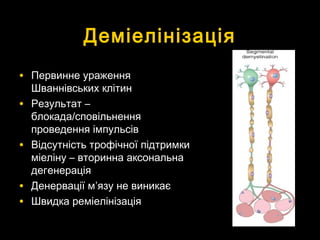 ДеміелінізаціяДеміелінізація
• Первинне ураженняПервинне ураження
Шваннівських клітинШваннівських клітин
• Результат –Результат –
блокадаблокада//сповільненнясповільнення
проведення імпульсівпроведення імпульсів
• Відсутність трофічної підтримкиВідсутність трофічної підтримки
міеліну – вторинна аксональнаміеліну – вторинна аксональна
дегенераціядегенерація
• Денервації мДенервації м’’язу не виникаєязу не виникає
• Швидка реміелінізаціяШвидка реміелінізація
 
