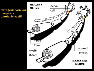 Патофізіологічний
результат
деміелінізаціїї
 