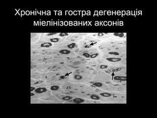 Хронічна та гостра дегенераціяХронічна та гостра дегенерація
міелінізованих аксонівміелінізованих аксонів
 