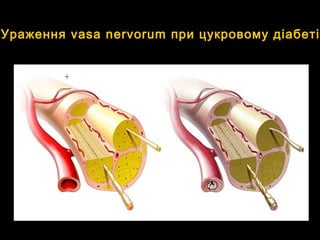 Ураження vasa nervorum при цукровому діабеті
 