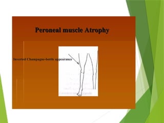 Peroneal Muscle Atrophy
 