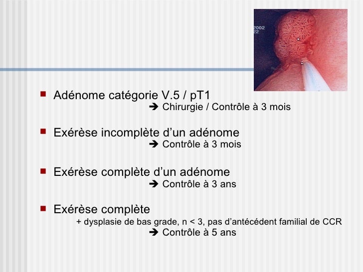 Adénome Tubuleux En Dysplasie De Bas Grade Catégorie 3