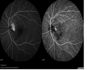 Polypoidal Amd Polypoidal Choroidal Vasculopathy | PPT