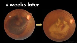 4 weeks later
Dr MBOUSSOU Yoan
 