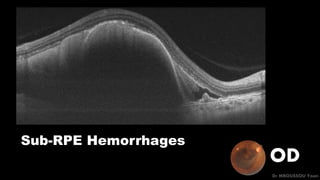 OD
Dr MBOUSSOU Yoan
Sub-RPE Hemorrhages
 