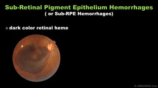 Sub-Retinal Pigment Epithelium Hemorrhages
( or Sub-RPE Hemorrhages)
Dr MBOUSSOU Yoan
 