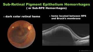 Sub-Retinal Pigment Epithelium Hemorrhages
( or Sub-RPE Hemorrhages)
Dr MBOUSSOU Yoan
 