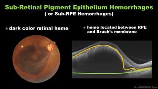 Sub-Retinal Pigment Epithelium Hemorrhages
( or Sub-RPE Hemorrhages)
Dr MBOUSSOU Yoan
 