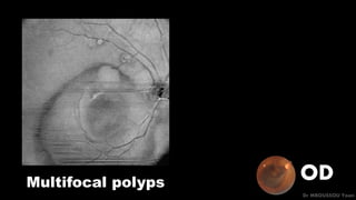 OD
Dr MBOUSSOU Yoan
Multifocal polyps
 
