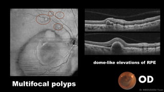 OD
Dr MBOUSSOU Yoan
dome-like elevations of RPE
Multifocal polyps
 