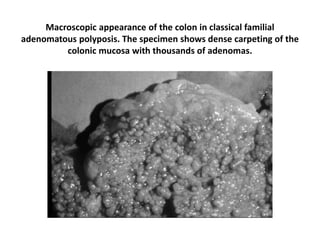 Macroscopic appearance of the colon in classical familial
adenomatous polyposis. The specimen shows dense carpeting of the
colonic mucosa with thousands of adenomas.
 