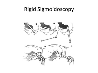 Rigid Sigmoidoscopy
 
