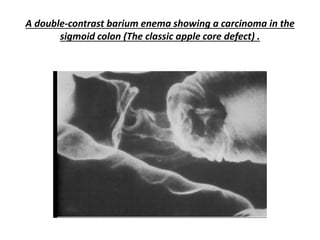 A double-contrast barium enema showing a carcinoma in the
sigmoid colon (The classic apple core defect) .
 