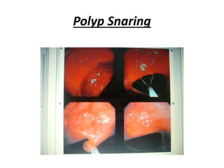 Polyp Snaring
 