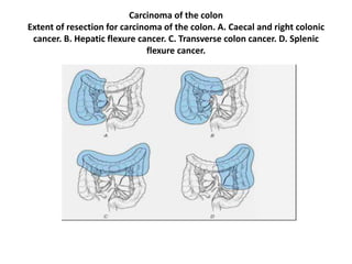 Carcinoma of the colon
Extent of resection for carcinoma of the colon. A. Caecal and right colonic
cancer. B. Hepatic flexure cancer. C. Transverse colon cancer. D. Splenic
flexure cancer.
 