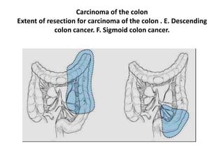 Carcinoma of the colon
Extent of resection for carcinoma of the colon . E. Descending
colon cancer. F. Sigmoid colon cancer.
 