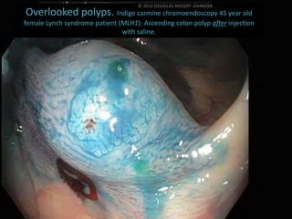 © 2014 DOUGLAS RIEGERT-JOHNSON 
Overlooked polyps. Indigo carmine chromoendoscopy 45 year old 
female Lynch syndrome patie...
