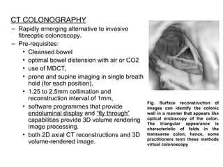 polypsandmalignancyoflargebowel-190525120300.ppt