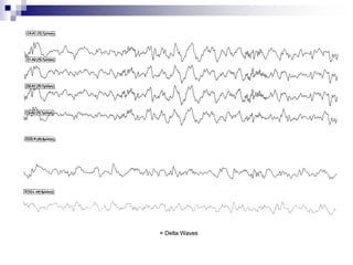 Polysomnogram interpretation by dr md abdullah saleem | PPTX