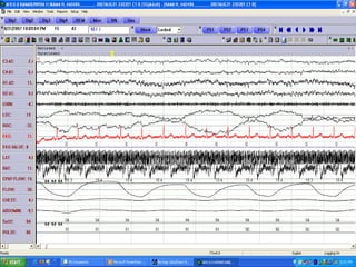 Polysomnography: recording and sleep staging | PPT