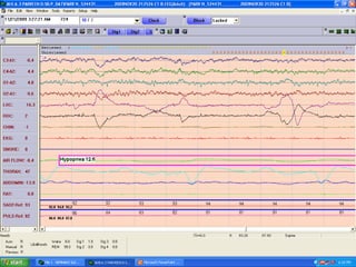 Polysomnography: recording and sleep staging | PPT