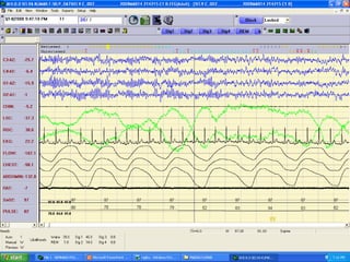 Polysomnography: recording and sleep staging | PPT