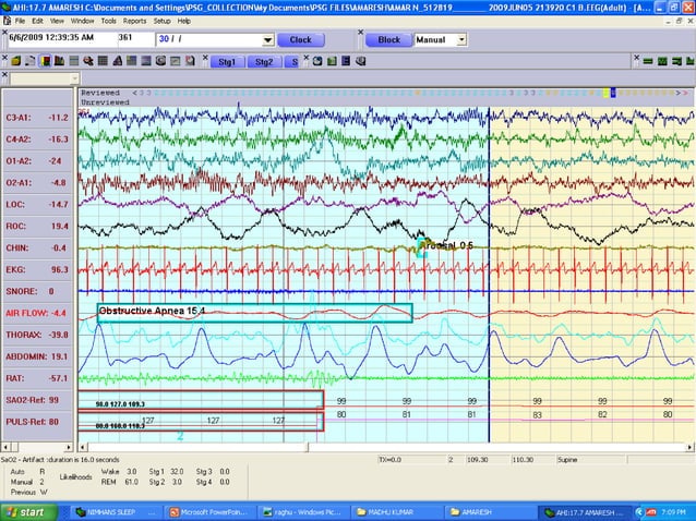 Polysomnography: recording and sleep staging