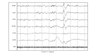 Polysomnography
