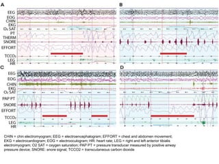 CHIN = chin electromyogram; EEG = electroencephalogram; EFFORT = chest and abdomen movement;
EKG = electrocardiogram; EOG = electrooculogram; HR: heart rate; LEG = right and left anterior tibialis
electromyogram; O2 SAT = oxygen saturation; PAP PT = pressure transducer measured by positive airway
pressure device; SNORE: snore signal; TCCO2 = transcutaneous carbon dioxide.
 
