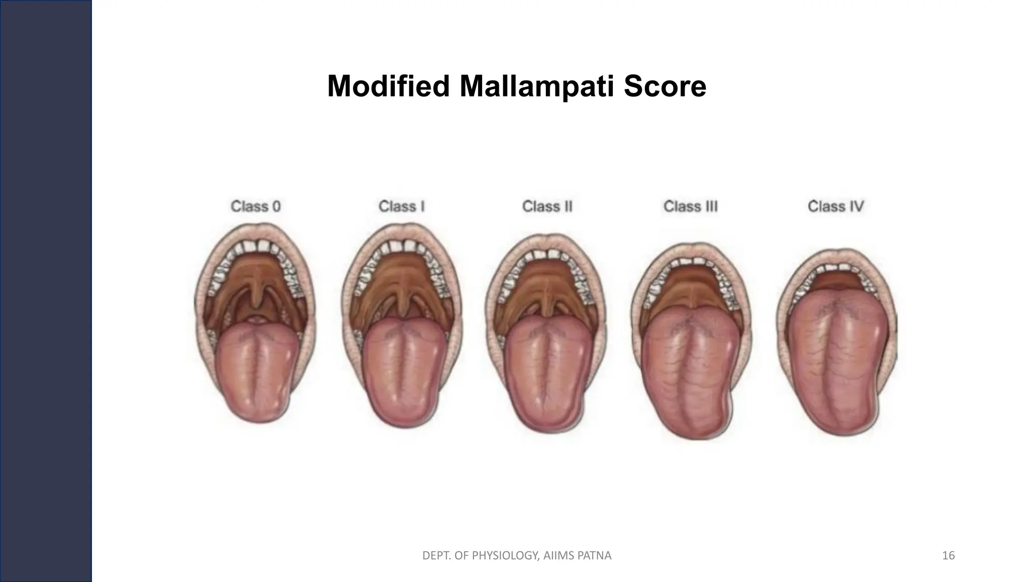Modified Mallampati Score
DEPT. OF PHYSIOLOGY, AIIMS PATNA 16
 