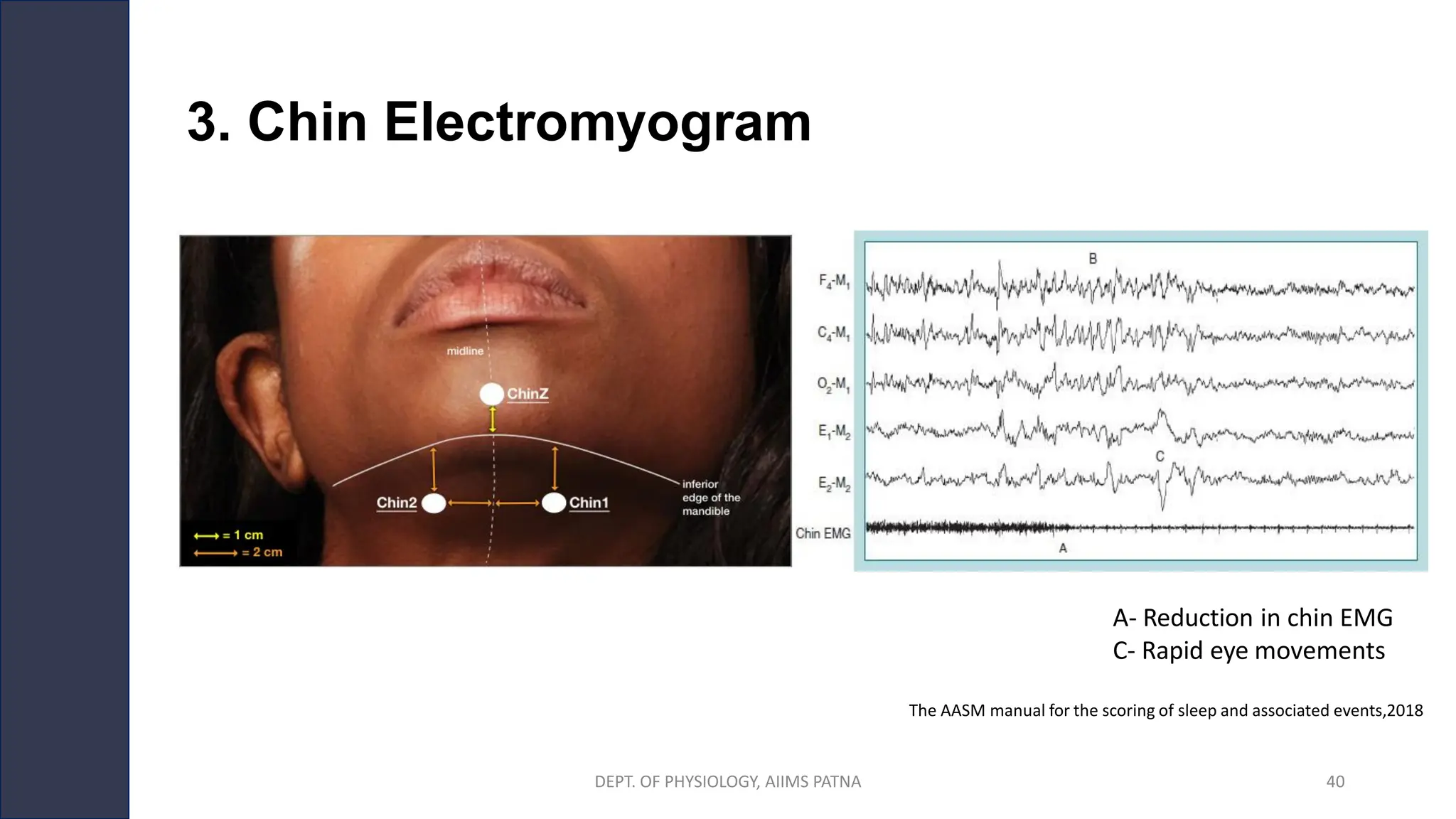 3. Chin Electromyogram
A- Reduction in chin EMG
C- Rapid eye movements
The AASM manual for the scoring of sleep and associated events,2018
DEPT. OF PHYSIOLOGY, AIIMS PATNA 40
 