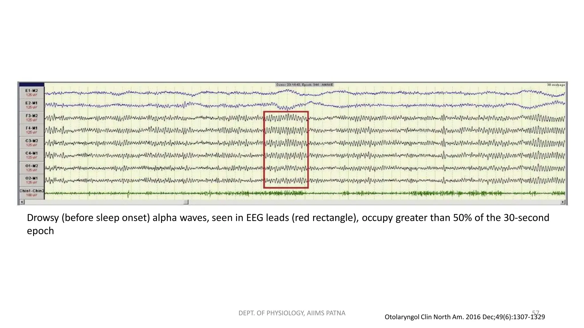 Drowsy (before sleep onset) alpha waves, seen in EEG leads (red rectangle), occupy greater than 50% of the 30-second
epoch
Otolaryngol Clin North Am. 2016 Dec;49(6):1307-1329
DEPT. OF PHYSIOLOGY, AIIMS PATNA 57
 