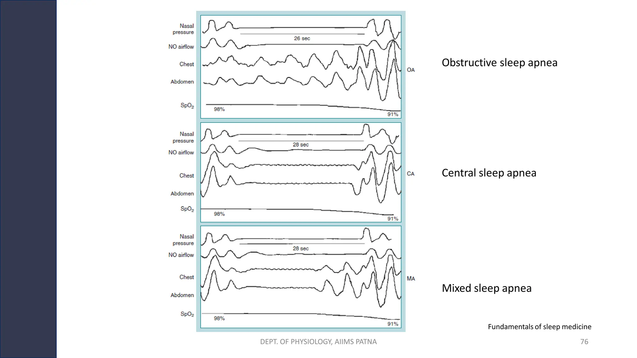 Fundamentals of sleep medicine
Central sleep apnea
Obstructive sleep apnea
Mixed sleep apnea
DEPT. OF PHYSIOLOGY, AIIMS PATNA 76
 