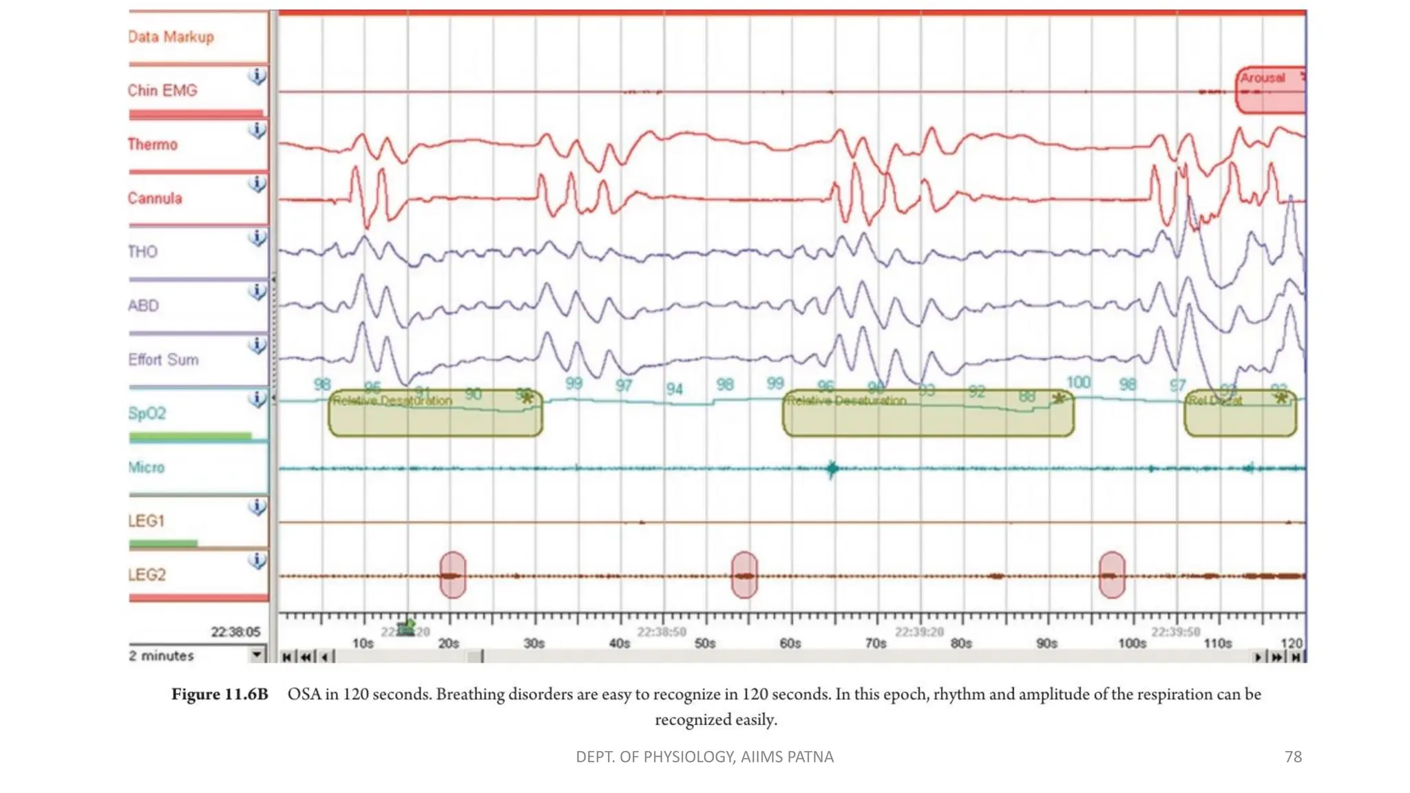 DEPT. OF PHYSIOLOGY, AIIMS PATNA 78
 