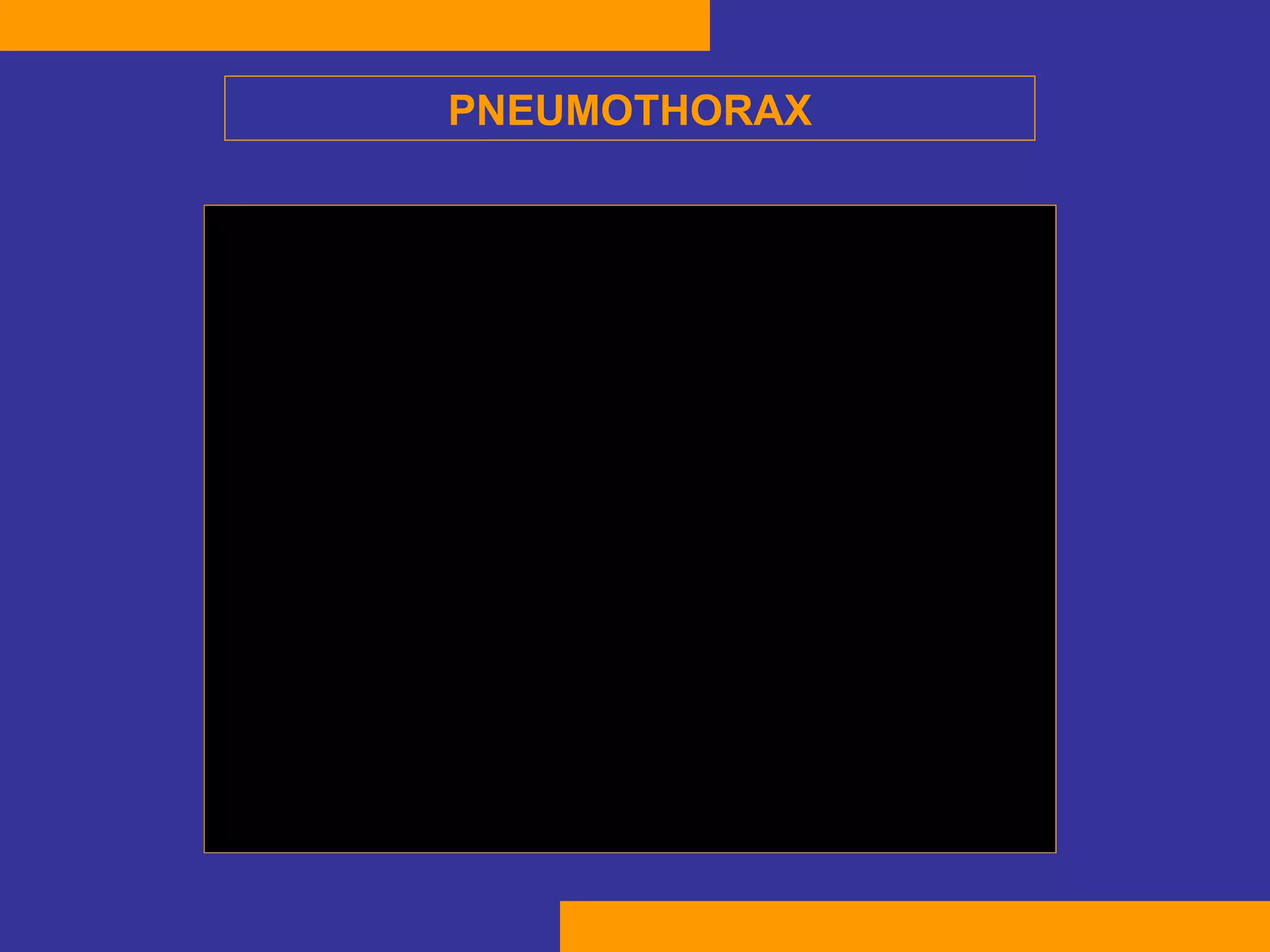 PNEUMOTHORAX 