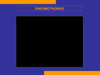 PNEUMOTHORAX 