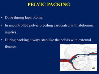 PELVIC PACKING
• Done during laparotomy.
• In uncontrolled pelvic bleeding associated with abdominal
injuries .
• During packing always stabilise the pelvis with external
fixators.
 