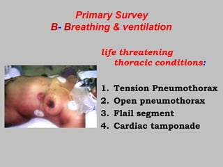 Primary Survey
B- Breathing & ventilation
life threatening
thoracic conditions:
1. Tension Pneumothorax
2. Open pneumothorax
3. Flail segment
4. Cardiac tamponade
 