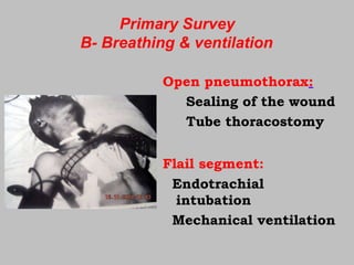 Primary Survey
B- Breathing & ventilation
Open pneumothorax:
Sealing of the wound
Tube thoracostomy
Flail segment:
Endotrachial
intubation
Mechanical ventilation
 