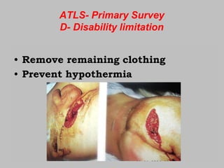ATLS- Primary Survey
D- Disability limitation
• Remove remaining clothing
• Prevent hypothermia
 