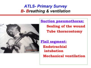 ATLS- Primary Survey
B- Breathing & ventilation
Five life threatening
thoracic conditions:
1. Tension Pneumothorax
2. Massive Pneumothorax
3. Open pneumothorax
4. Flail segment
5. Cardiac tamponade
 