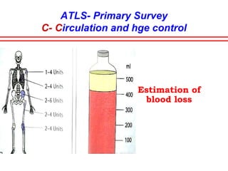 ATLS- Primary Survey
C- Circulation and hge control
Immediate responders-<20% blood loss
Bleeding ceases
spontaneously
Transient responders-
bleeding within body
cavities
Surgical intervention reqd.
Non responders-
>40% of blood vol lost
require immediate surgery
Continued IV fluids detrimental
 