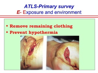 ATLS- Primary Survey
C- Circulation and hge control
Estimation of
blood loss
 